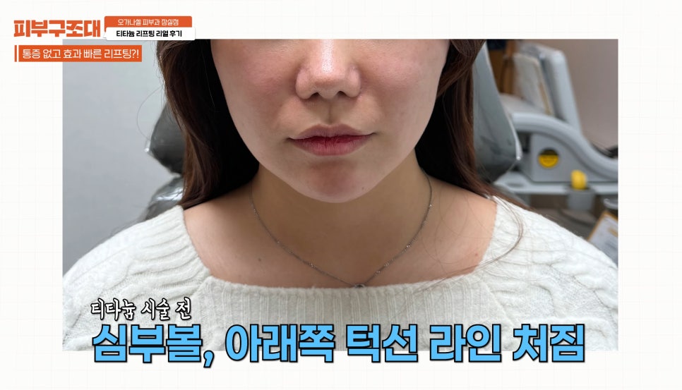 잠실새내 피부과 티타늄리프팅 주의사항 필독! 관련 이미지 10