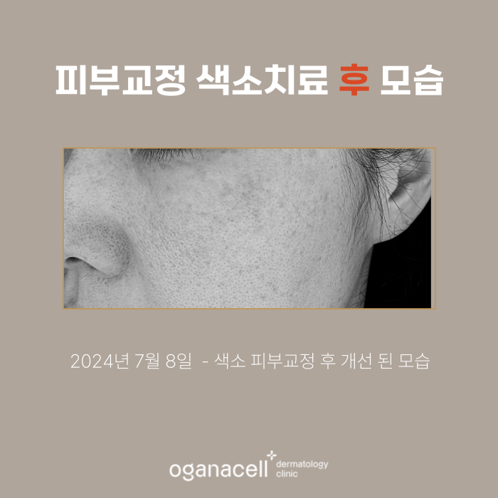 잠실피부과 색소 교정 실제사례 전후 비교 관련 이미지 3
