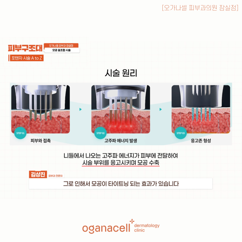 잠실 포텐자 피부과 모공관리 방법 관련 이미지 4