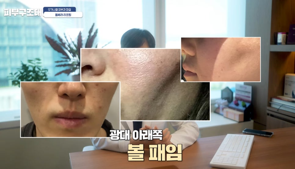 잠실울쎄라 부작용 볼패임을 피하려면? 관련 이미지 7