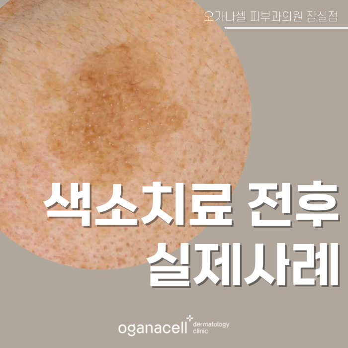 잠실역색소치료 색소제거 전후 비교 후기 관련 이미지 1