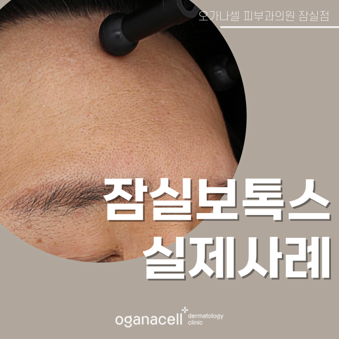 잠실 이마보톡스 전후 비교 후기 관련 이미지 1