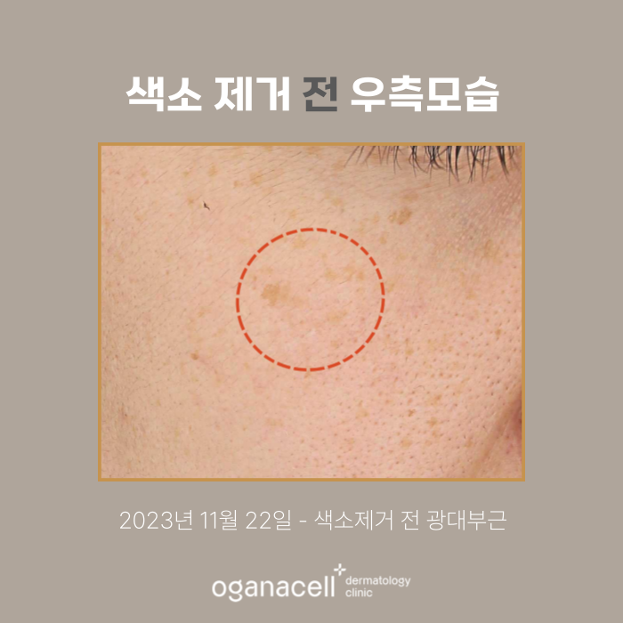 잠실색소제거 실제사례 전후 비교 관련 이미지 2