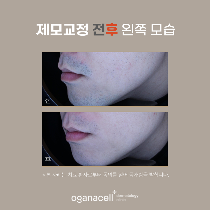 잠실역피부과 제모 남자수염 실제사례(+피부톤개선) 관련 이미지 4