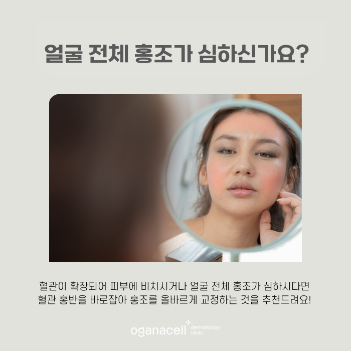 잠실 안면홍조 유형과 원인에 따라 교정해 주는 곳 관련 이미지 4