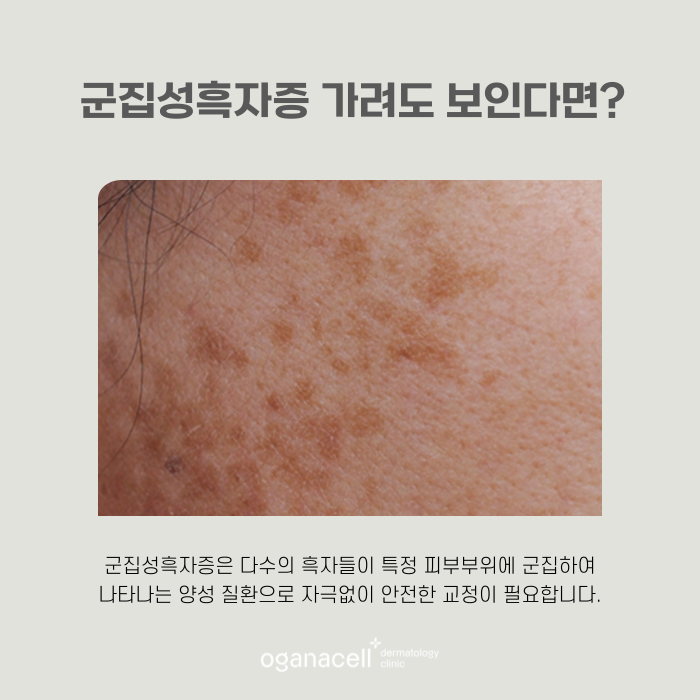 얼굴모반 우리아이한테도 보인다면 관련 이미지 6