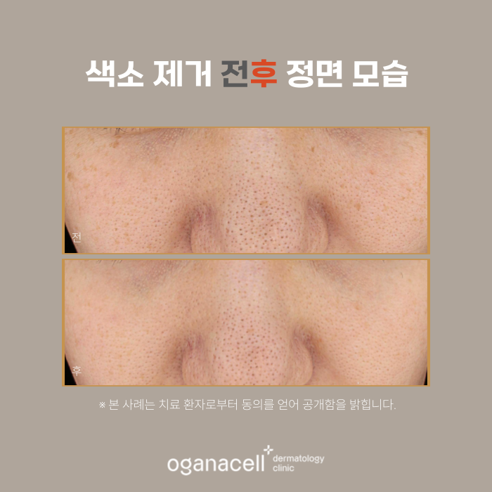 잠실색소제거 실제사례 전후 비교 관련 이미지 5