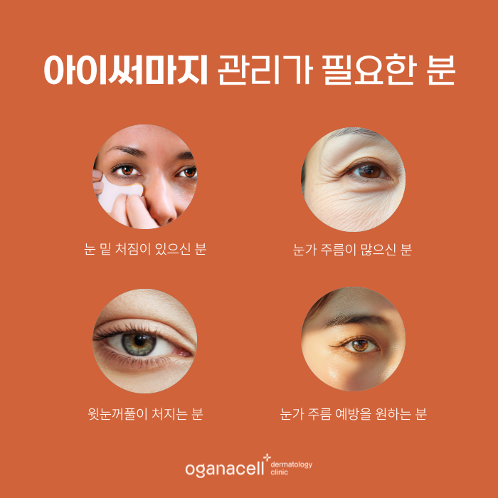 잠실 아이써마지 눈가, 눈밑, 눈꺼풀 처짐 있는 분들이라면 관련 이미지 3
