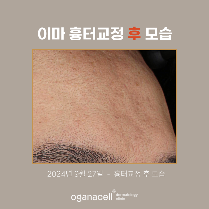 Forehead Scar Correction: Actual Case Before and After Comparison image 3