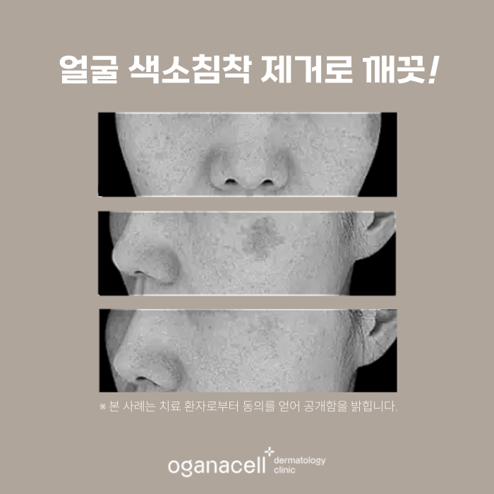 잠실피부과 색소 교정 실제사례 전후 비교 관련 이미지 4