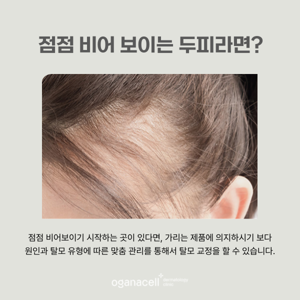 머리카락 빠지는 원인 잡고 탈모교정하는법 관련 이미지 4