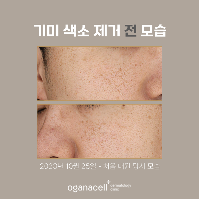 잠실피부과 기미 색소 제거 실제 후기 관련 이미지 2