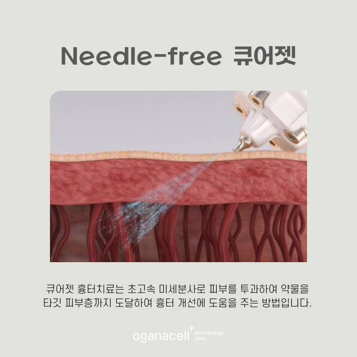 큐어젯 흉터 잠실역에 잘하는 곳 관련 이미지 5