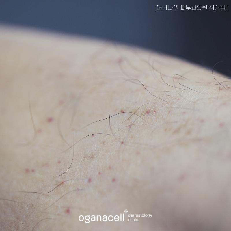 Jamsil Hair Removal: Start Preparing for Summer Now image 6