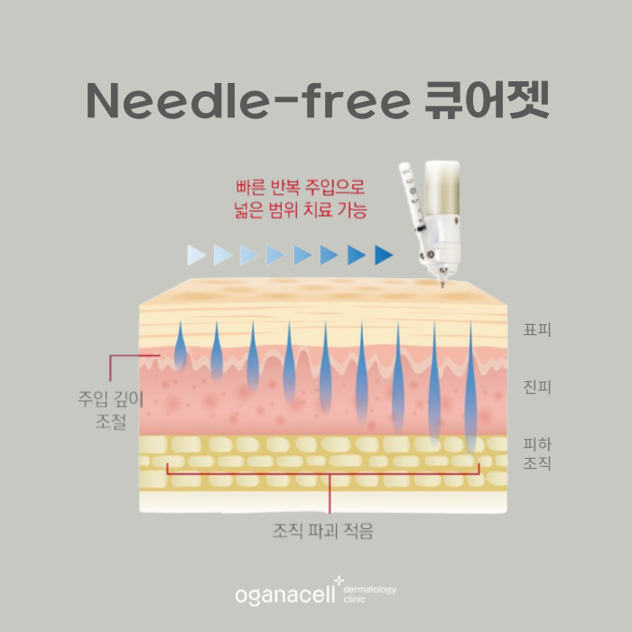 잠실 여드름큐어젯 잘하는 곳 관련 이미지 7
