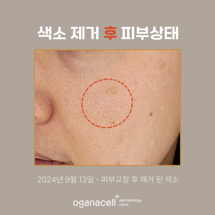 40대색소제거 전후 비교 후기 관련 이미지 3