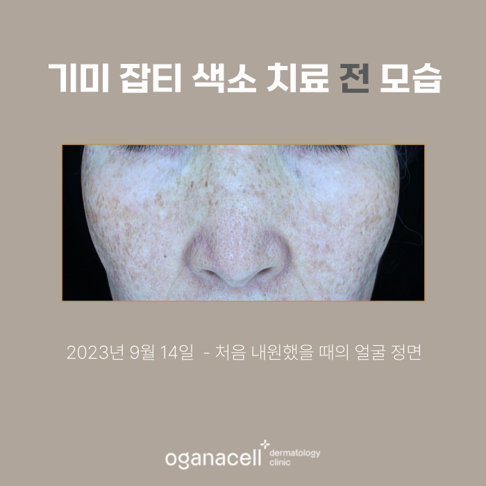60대 기미 제거 전후 비교 실제사례 관련 이미지 2