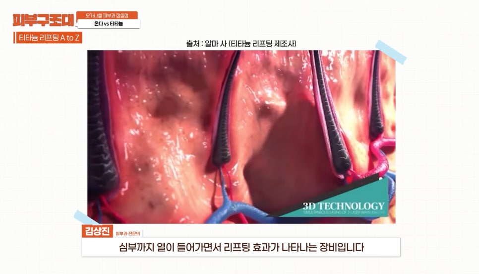 잠실 온다 티타늄 리프팅 피부과, 즉각적인 효과를 주는 건? 관련 이미지 9