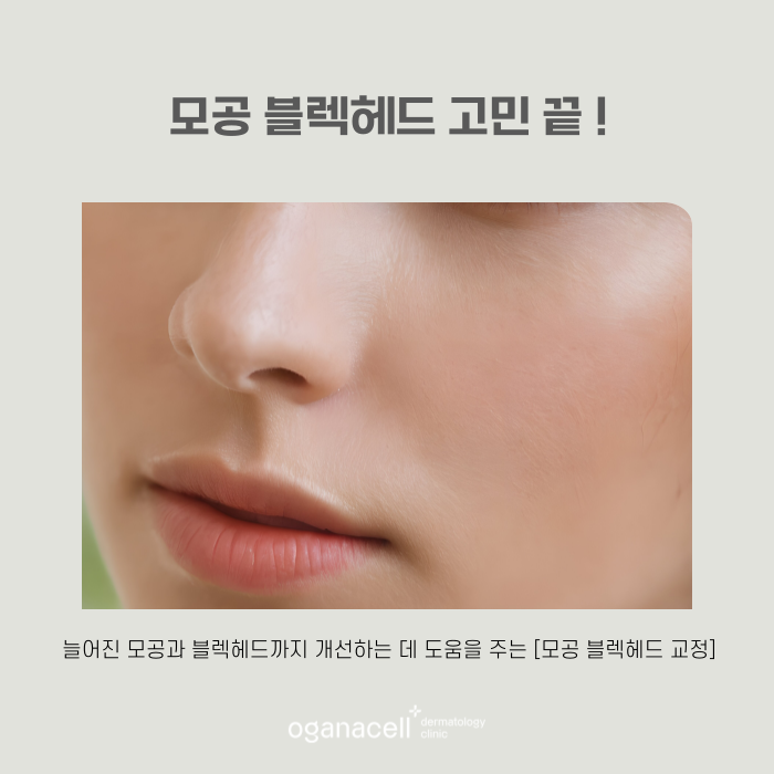 모공 줄이는 법, 커지는 원인부터 알아야 합니다 관련 이미지 7