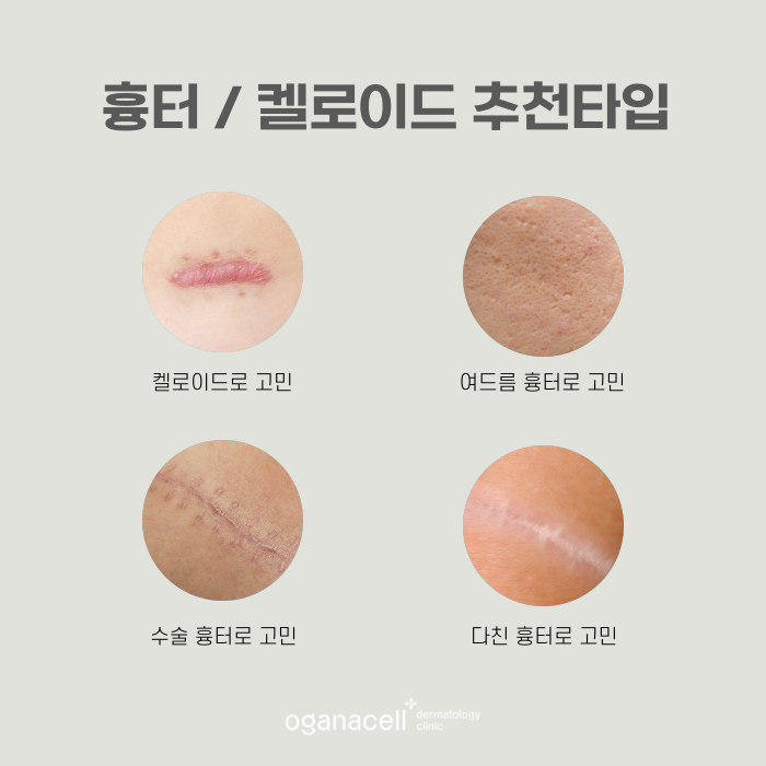 튀어나온 흉터 켈로이드 특징과 치료 시기 관련 이미지 5