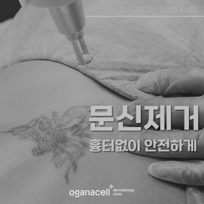 안전하게 문신제거하는 법 관련 이미지 1
