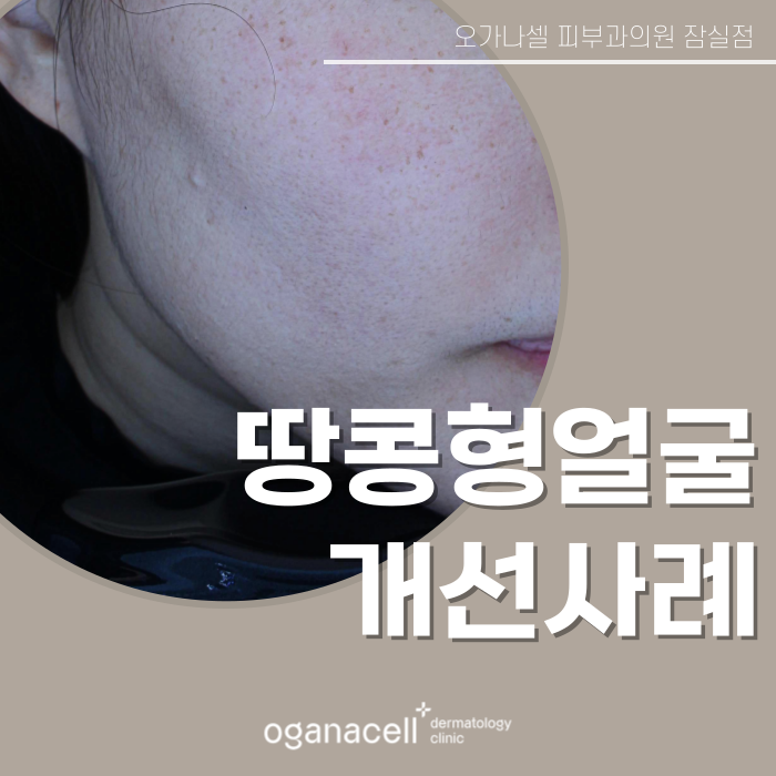 잠실역 스컬트라 관리 실제사례 후기 관련 이미지 1