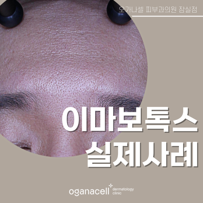 잠실보톡스 이마 쁘띠교정 전후 모습 비교 관련 이미지 1