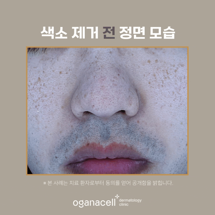 잠실피부과 기미 색소 제거 실제 후기 관련 이미지 4