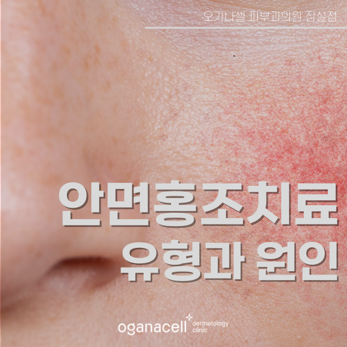 잠실 안면홍조 유형과 원인에 따라 교정해 주는 곳 관련 이미지 1
