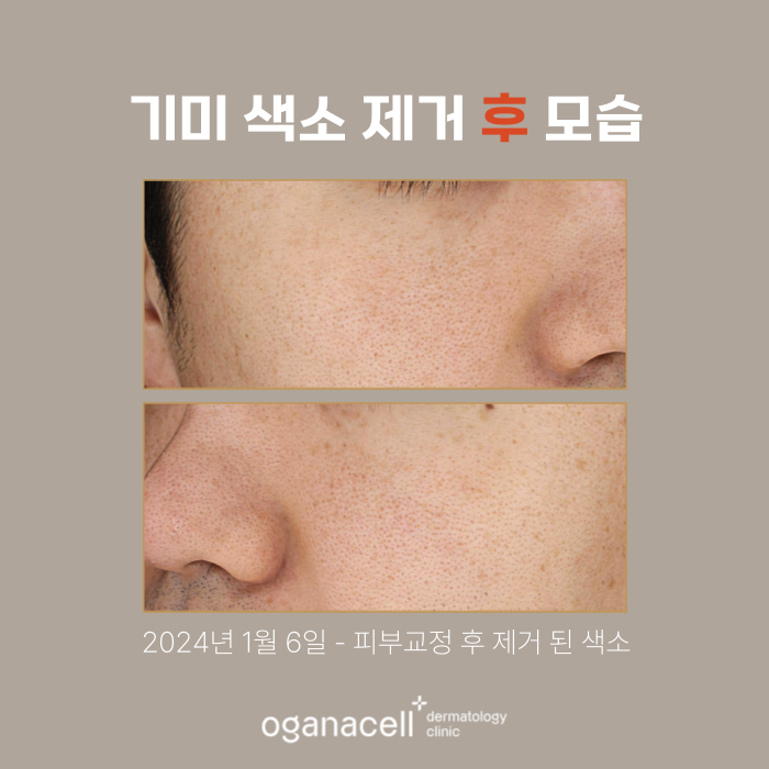 잠실피부과 기미 색소 제거 실제 후기 관련 이미지 3