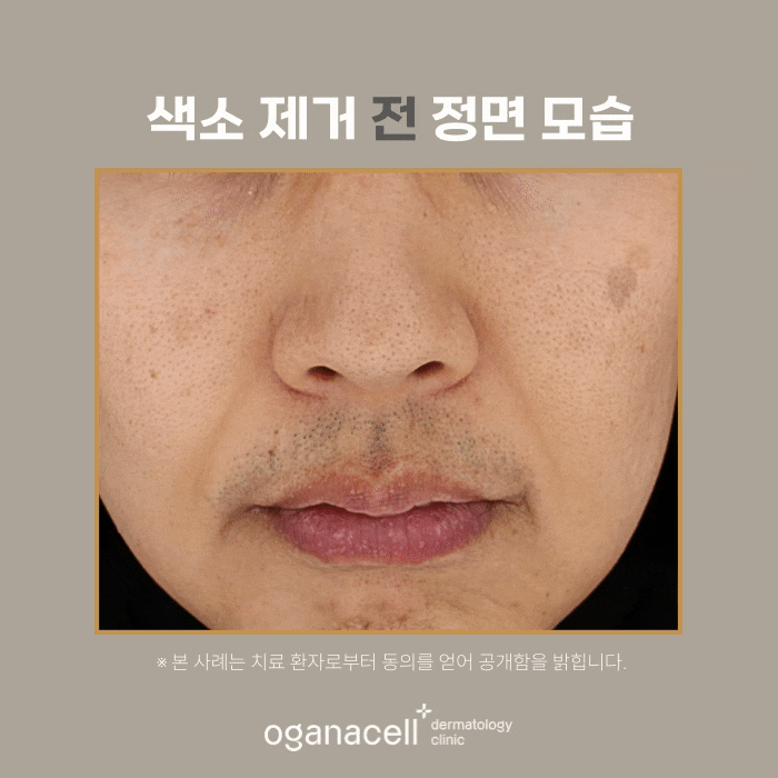 40대색소제거 전후 비교 후기 관련 이미지 4