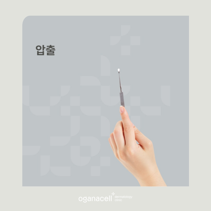 사춘기성 등 여드름압출잘하는곳 잠실피부과 관련 이미지 11