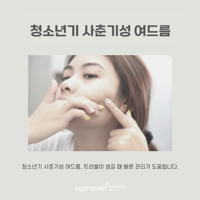 사춘기성 등 여드름압출잘하는곳 잠실피부과 관련 이미지 6