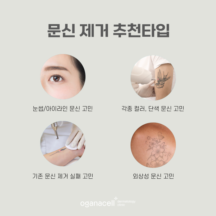 안전하게 문신제거하는 법 관련 이미지 5
