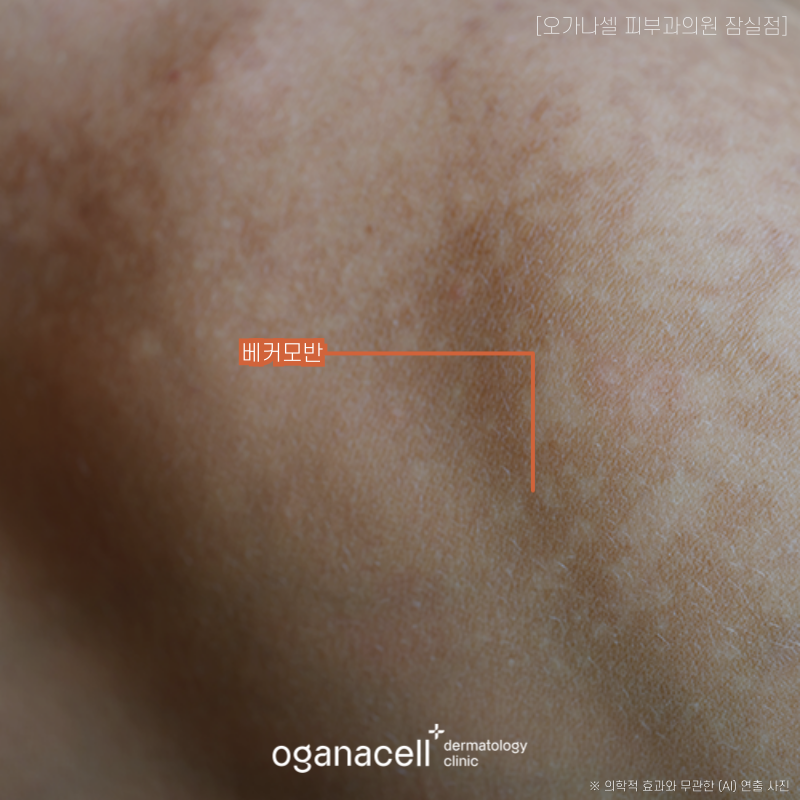 난치성 색소 치료 방법 밀크커피반점, 베커모반, 군집성흑자증, 오타모반 의심될 때 관련 이미지 3
