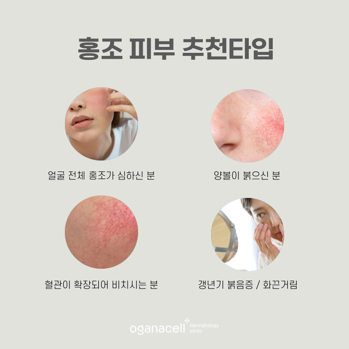 홍조 원인 잡으면 얼굴이 밝아 보여요 관련 이미지 5