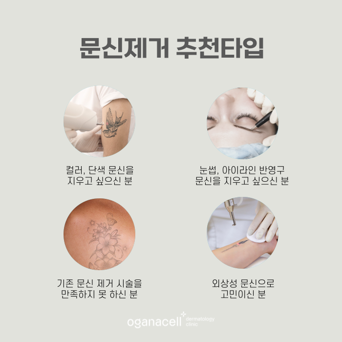 잠실역1번출구 문신제거 잘하는 곳 관련 이미지 3