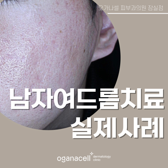 남자여드름피부 잠실피부과 흉터교정 전후 비교 관련 이미지 1
