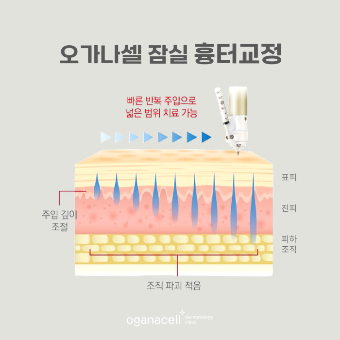 큐어젯 흉터 잠실역에 잘하는 곳 관련 이미지 7