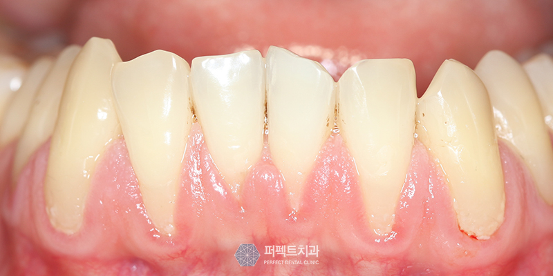 잇몸퇴축 원인과 문제점은? 관련 이미지 2