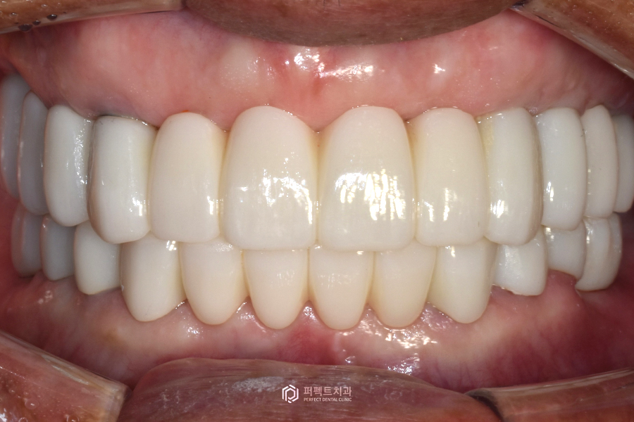 살릴 수 있는 치아가 없다면?❌｜전체임플란트 수복 관련 이미지 6