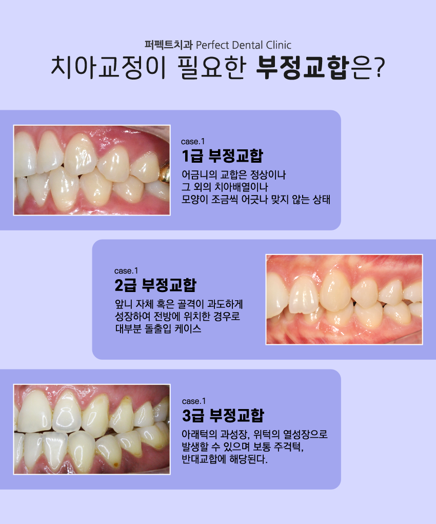 부정교합 치아교정은~? 관련 이미지 2
