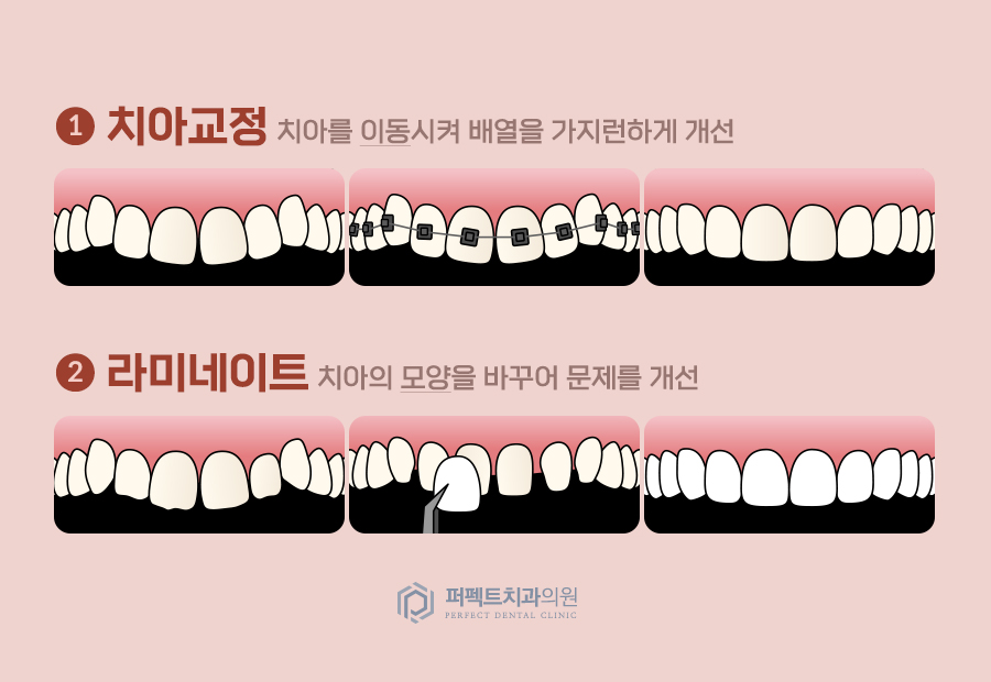 라미네이트 치료 시 참고사항은? 관련 이미지 2