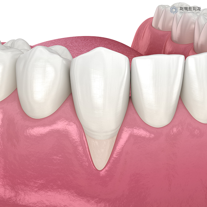 교정 후 잇몸퇴축은 흔하게 생기나요? 관련 이미지 4