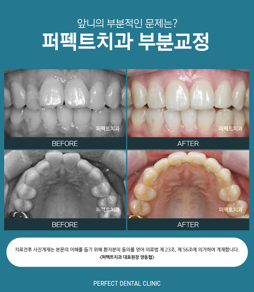 치아안쪽에 교정하는 설측교정! 관련 이미지 3