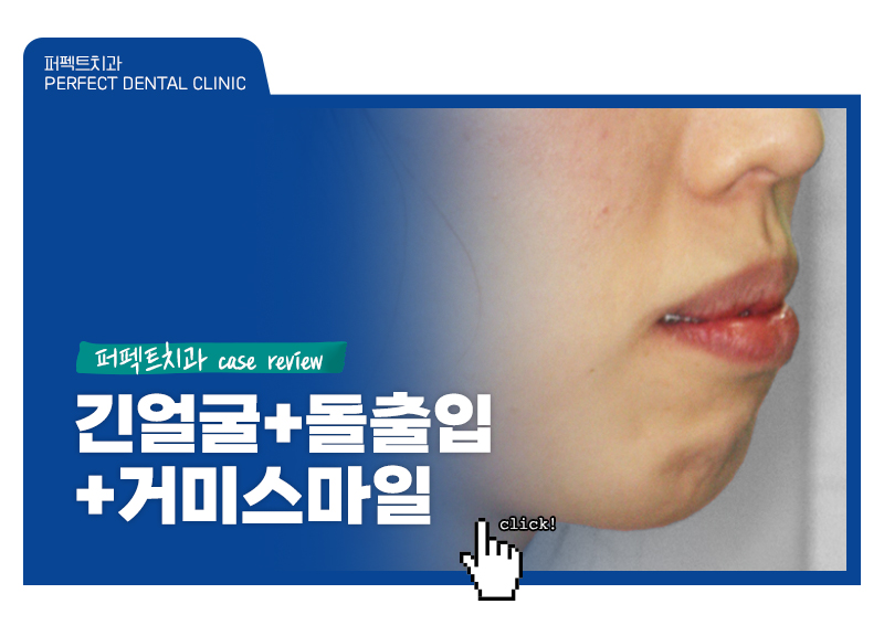 긴얼굴+돌출입+거미스마일 비수술교정case 관련 이미지 1
