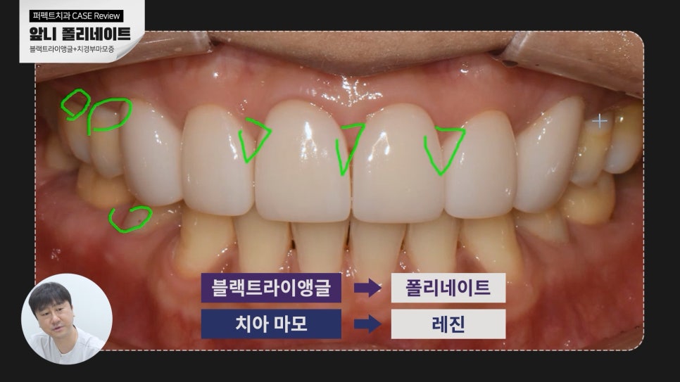 블랙트라이앵글+노란치아 폴리네이트 case 관련 이미지 4