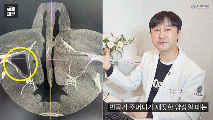 치통의 원인이 될 수 있는 상악동염이란? 관련 이미지 3