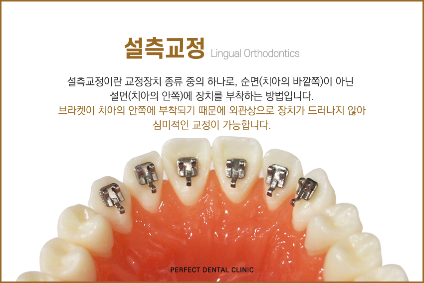 치아안쪽에 부착하는 설측교정! 관련 이미지 2