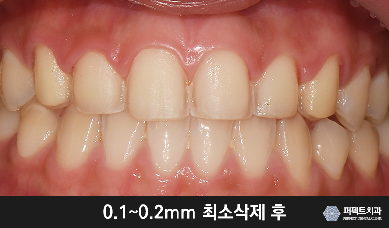 치과, 앞니 라미네이트 가격 관련 이미지 3
